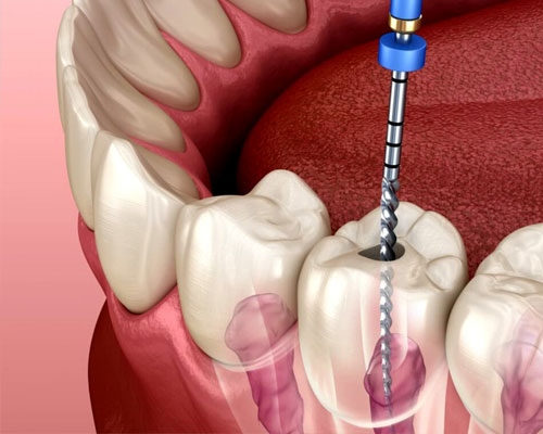 Root Canal Treatment by Dr. Monika Sonawane, a highly respected dentist at All Dent, Dental Clinic in Ulwe, Navi Mumbai.